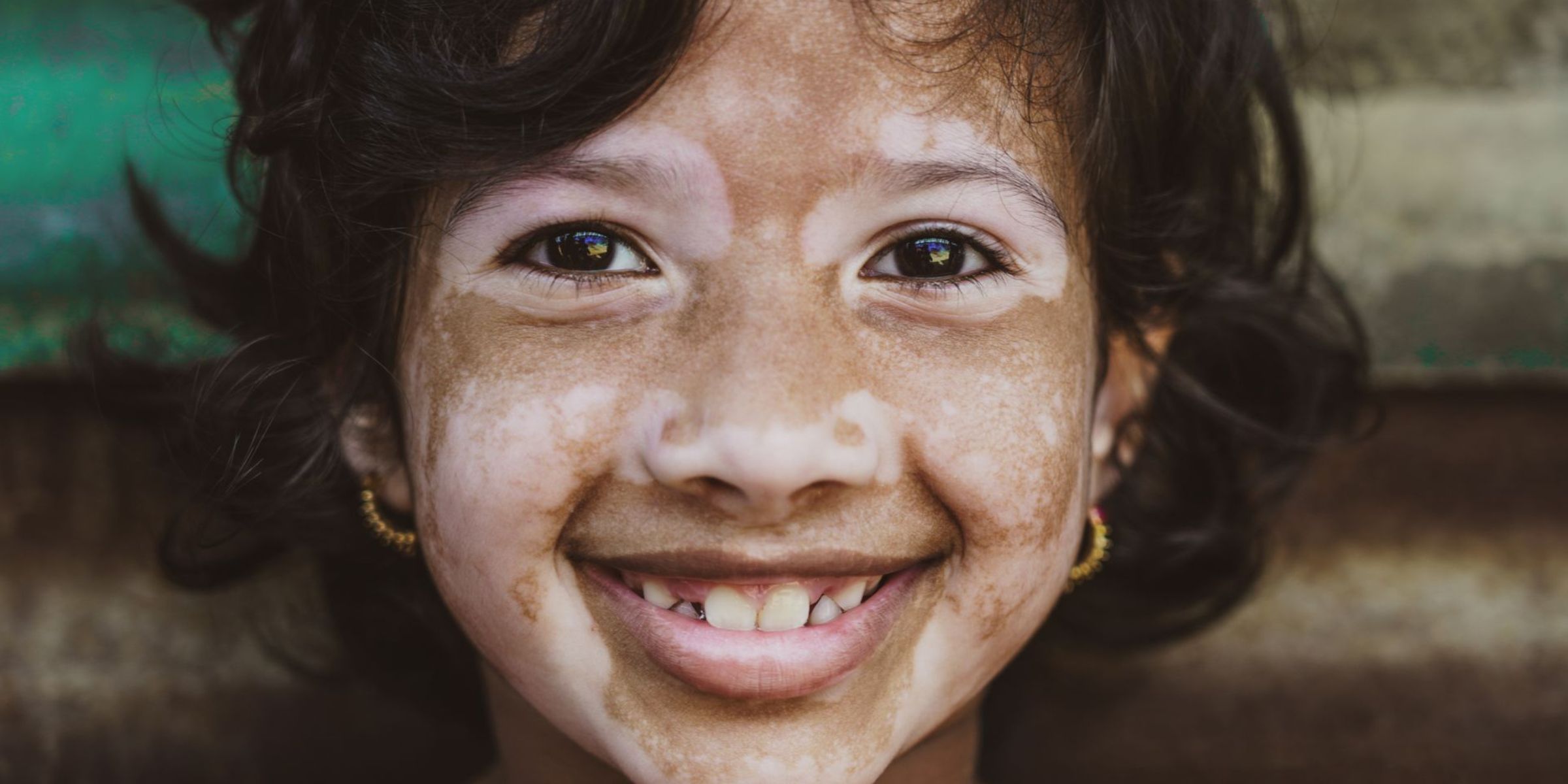 Smiling young girl with distinctive facial pigmentation | Source: Pexels
