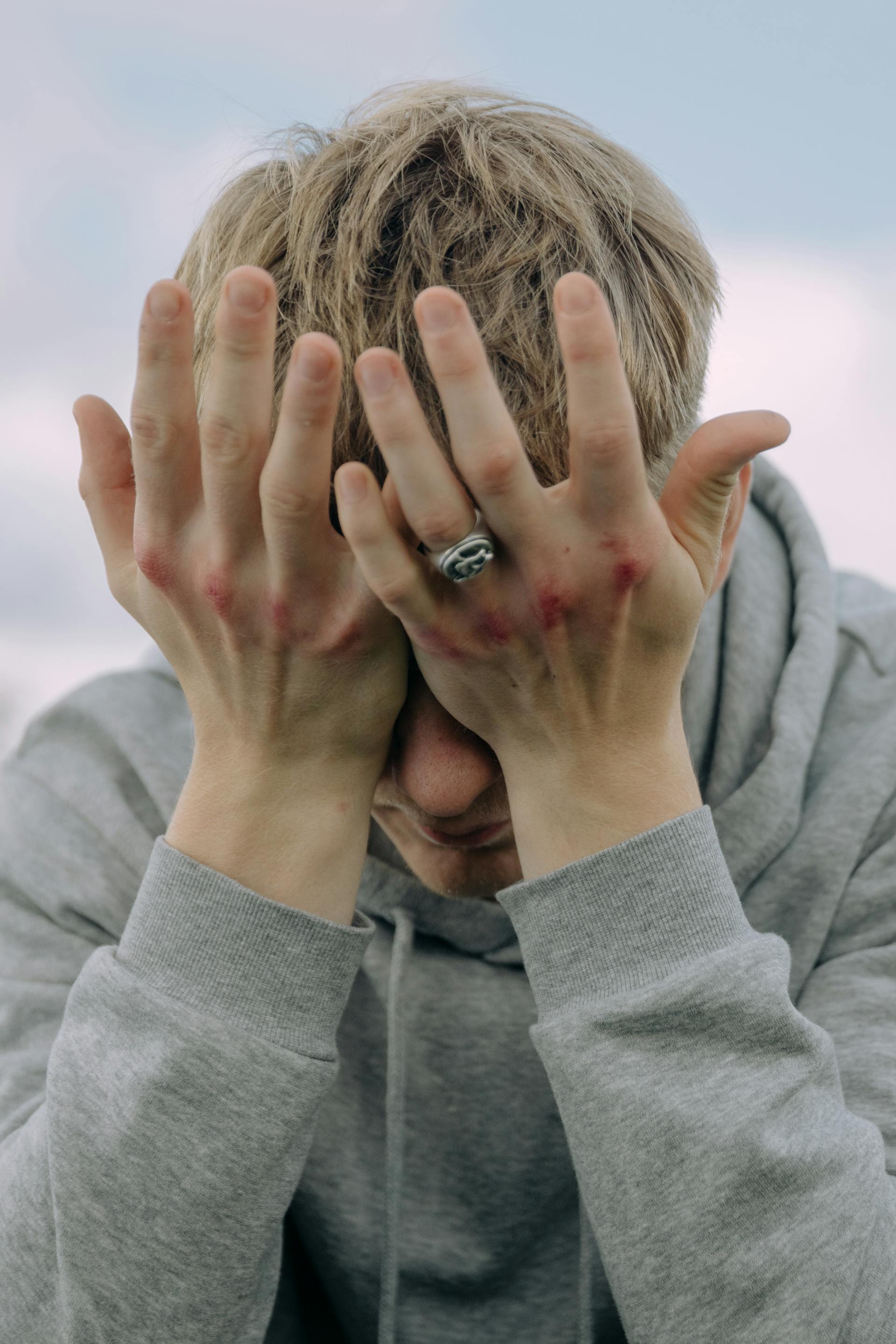 A man with bruised knuckles covering his face with his hands | Source: Pexels