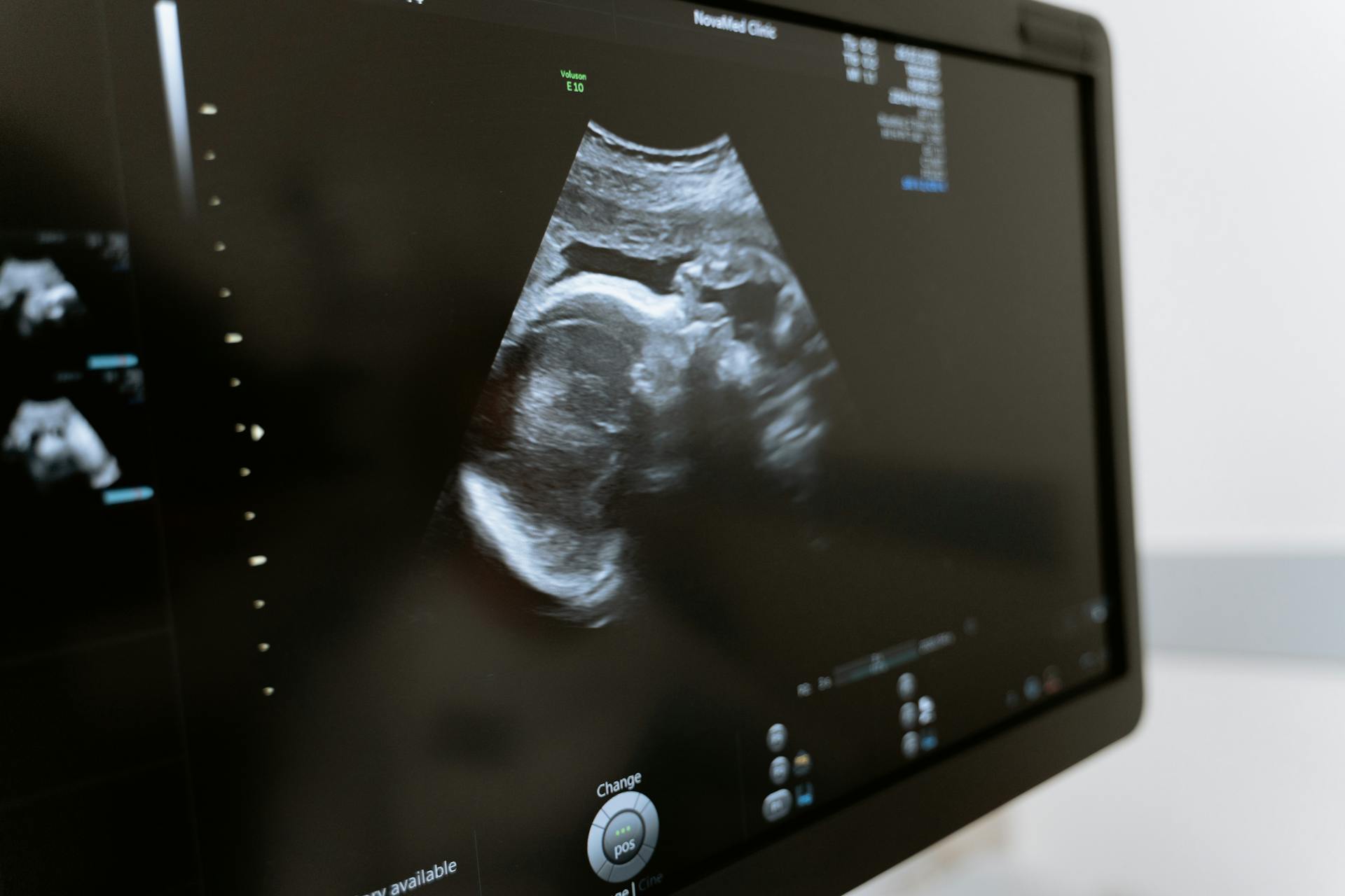 An ultrasound scan on a computer | Source: Pexels